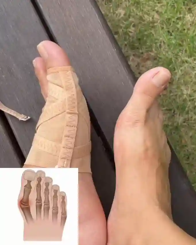HaluStoper w akcji, miękki separator na stopie podczas noszenia