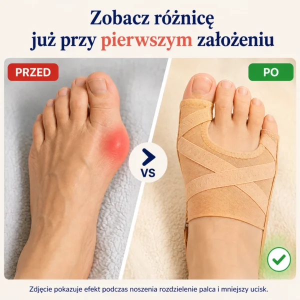 HaluStoper - Korektor Haluksów łagodzący ból i zapobiegający otarciom